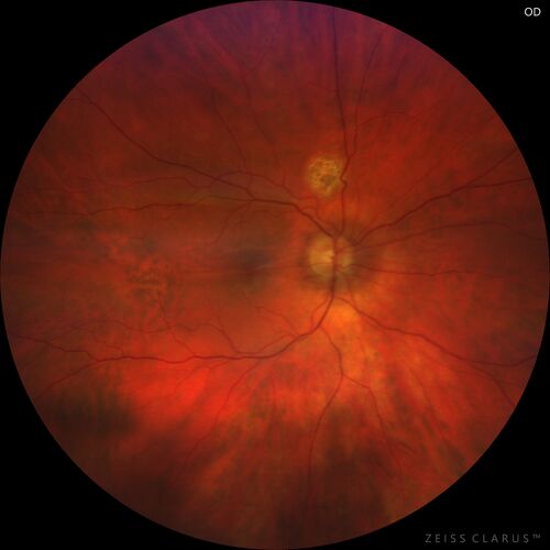 Macular fold - resolved with time
