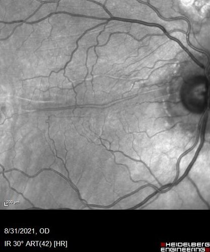 Macular fold - resolved with time
