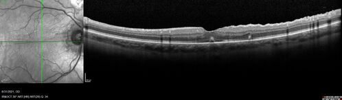 Macular fold - resolved with time
