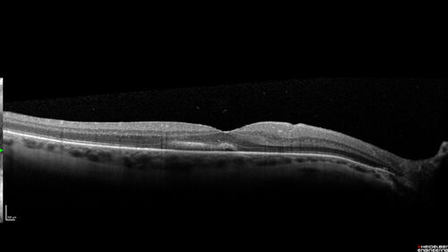 Macular fold - resolved with time
