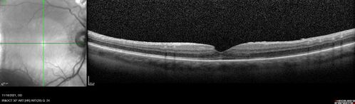 Macular fold - resolved with time
