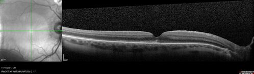 Macular fold - resolved with time
