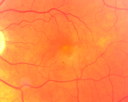 Wet AMD 62 year old male smoker 
62-year-old man has wet age-related macular degeneration in the right eye.  He has been undergoing treatment with Lucentis for that.  Then his left eye developed hazy vision a few weeks ago while he was overseas and now his vision is hazy in both eyes.   OD 20/40, OS 20/30.    FA shows a classic subfoveal choroidal neovascular membrane in the left eye, which is leaking and in the right eye, which is dry. He is going to stop smoking today. FU: VA 20/30 OU with 2 years of every 6 weeks bilateral avastin!
Palabras clave: wet amd; smoker; avastin; bilateral