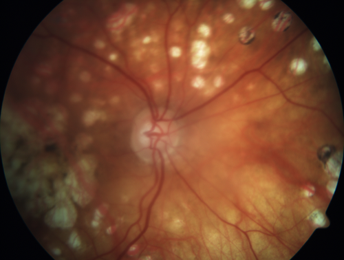 Macular Laser Scars
86 year old man who had Laser done from 2010 - 2018 for diabetic retinopathy.  The right eye lost vision immediately after laser was done a few years ago.  VA 1/200 OD; 20/25 OS
