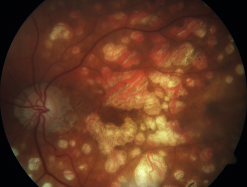 Macular Laser Scars
86 year old man who had Laser done from 2010 - 2018 for diabetic retinopathy.  The right eye lost vision immediately after laser was done a few years ago.  VA 1/200 OD; 20/25 OS
