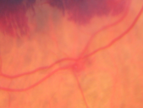 Ruptured Retinal Arterial Macroaneurysm - Submacular Hemorrhage - Vision 20/400 never recovered - Hypertension 205/94
