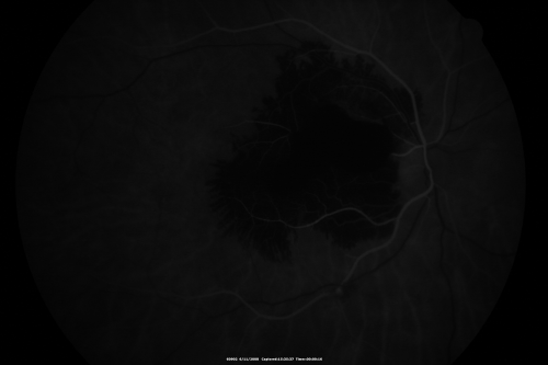 Ruptured Retinal Arterial Macroaneurysm - Submacular Hemorrhage - Vision 20/400 never recovered - Hypertension 205/94
