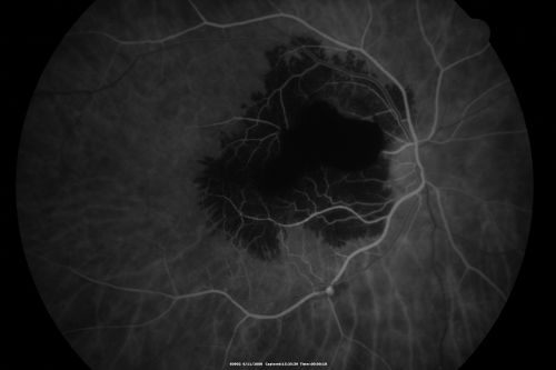 Ruptured Retinal Arterial Macroaneurysm - Submacular Hemorrhage - Vision 20/400 never recovered - Hypertension 205/94
