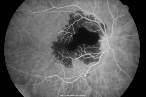 Ruptured Retinal Arterial Macroaneurysm - Submacular Hemorrhage - Vision 20/400 never recovered - Hypertension 205/94
