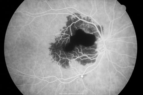 Ruptured Retinal Arterial Macroaneurysm - Submacular Hemorrhage - Vision 20/400 never recovered - Hypertension 205/94
