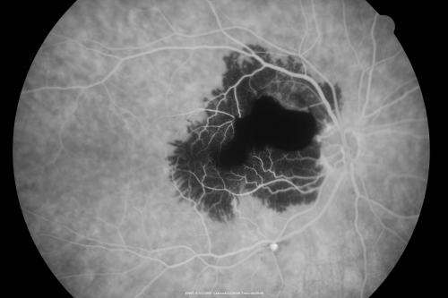 Ruptured Retinal Arterial Macroaneurysm - Submacular Hemorrhage - Vision 20/400 never recovered - Hypertension 205/94

