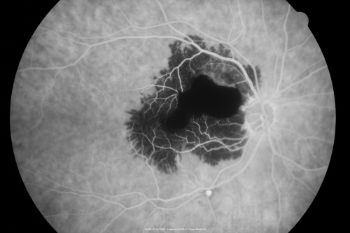 Ruptured Retinal Arterial Macroaneurysm - Submacular Hemorrhage - Vision 20/400 never recovered - Hypertension 205/94
