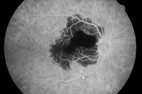 Ruptured Retinal Arterial Macroaneurysm - Submacular Hemorrhage - Vision 20/400 never recovered - Hypertension 205/94
