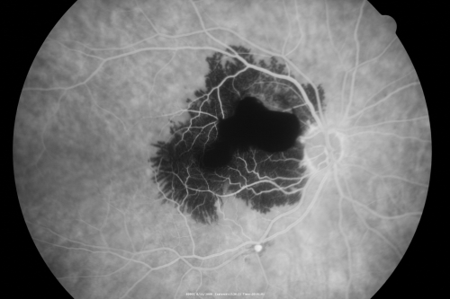 Ruptured Retinal Arterial Macroaneurysm - Submacular Hemorrhage - Vision 20/400 never recovered - Hypertension 205/94
