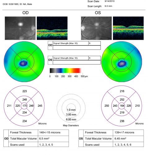 Occult Maculopathy - Thin Fovea on OCT and Normal Color VA, Photos, FA VA 20/80 OU
45-year-old man his mother and his maternal grandmother each had vision loss at a relatively young age.  OCT MAP shows foveal thinning.
Keywords: occult maculopathy;foveal atrophy