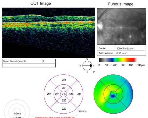 Branch Retinal Vein Occlusion with Macular Edema 3 Months after Intravitreal Kenalog and Grid Laser
Central foveal thickness came to normal after laser and intravitreal Kenalog
