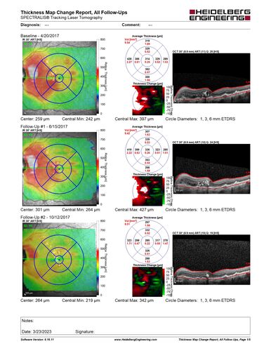 Asymptomatic wet AMD OS - never treated
Vision remains 20/20 at 6 year follow-up with no treatment
