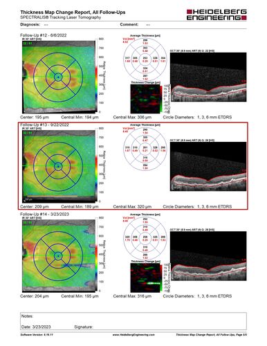 Asymptomatic wet AMD OS - never treated
Vision remains 20/20 at 6 year follow-up with no treatment
