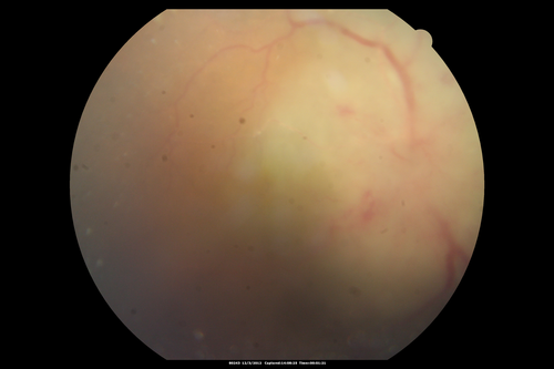 Uveitis - Retinitis - Vasculitis - possibly Syphilitis
Visit 1: 12-06-12
74-year-old man 12-3-12 visit.  2 months ago noticed vision loss, first in the right eye than the left.   He is getting tired easily.  He canâ€™t walk for a long distance.  He has lost five pounds within the last month. He also had a severe itchy episode, but not quite a rash a few days ago, which went away after he took a shower.  FTA-ABS is positive but a spinal tap, which was negative.  OD 1/200,  OS 20/63.  

