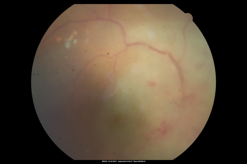 Uveitis - Retinitis - Vasculitis - possibly Syphilitis
Visit 1: 12-06-12
74-year-old man 12-3-12 visit.  2 months ago noticed vision loss, first in the right eye than the left.   He is getting tired easily.  He canâ€™t walk for a long distance.  He has lost five pounds within the last month. He also had a severe itchy episode, but not quite a rash a few days ago, which went away after he took a shower.  FTA-ABS is positive but a spinal tap, which was negative.  OD 1/200,  OS 20/63.  
