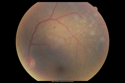 Uveitis - Retinitis - Vasculitis - possibly Syphilitis
Visit 1: 12-06-12
74-year-old man 12-3-12 visit.  2 months ago noticed vision loss, first in the right eye than the left.   He is getting tired easily.  He canâ€™t walk for a long distance.  He has lost five pounds within the last month. He also had a severe itchy episode, but not quite a rash a few days ago, which went away after he took a shower.  FTA-ABS is positive but a spinal tap, which was negative.  OD 1/200,  OS 20/63.  
