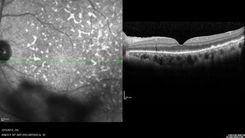 Uveitis - Retinitis - Vasculitis - possibly Syphilitis
Visit 1: 12-06-12
74-year-old man 12-3-12 visit.  2 months ago noticed vision loss, first in the right eye than the left.   He is getting tired easily.  He canâ€™t walk for a long distance.  He has lost five pounds within the last month. He also had a severe itchy episode, but not quite a rash a few days ago, which went away after he took a shower.  FTA-ABS is positive but a spinal tap, which was negative.  OD 1/200,  OS 20/63.  
