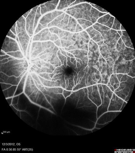 Uveitis - Retinitis - Vasculitis - possibly Syphilitis
Visit 1: 12-06-12
74-year-old man 12-3-12 visit.  2 months ago noticed vision loss, first in the right eye than the left.   He is getting tired easily.  He canâ€™t walk for a long distance.  He has lost five pounds within the last month. He also had a severe itchy episode, but not quite a rash a few days ago, which went away after he took a shower.  FTA-ABS is positive but a spinal tap, which was negative.  OD 1/200,  OS 20/63.  
