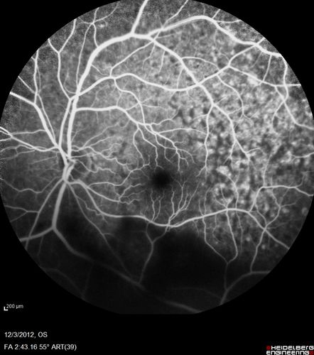 Uveitis - Retinitis - Vasculitis - possibly Syphilitis
Visit 1: 12-06-12
74-year-old man 12-3-12 visit.  2 months ago noticed vision loss, first in the right eye than the left.   He is getting tired easily.  He canâ€™t walk for a long distance.  He has lost five pounds within the last month. He also had a severe itchy episode, but not quite a rash a few days ago, which went away after he took a shower.  FTA-ABS is positive but a spinal tap, which was negative.  OD 1/200,  OS 20/63.  
