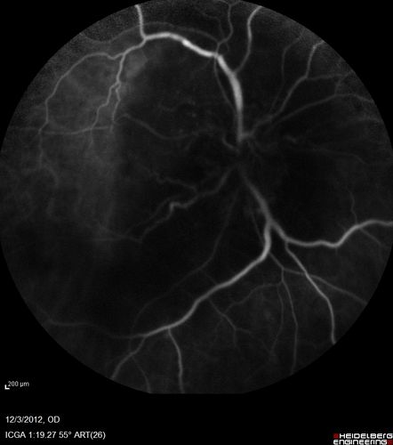 Uveitis - Retinitis - Vasculitis - possibly Syphilitis
Visit 1: 12-06-12
74-year-old man 12-3-12 visit.  2 months ago noticed vision loss, first in the right eye than the left.   He is getting tired easily.  He canâ€™t walk for a long distance.  He has lost five pounds within the last month. He also had a severe itchy episode, but not quite a rash a few days ago, which went away after he took a shower.  FTA-ABS is positive but a spinal tap, which was negative.  OD 1/200,  OS 20/63.  
