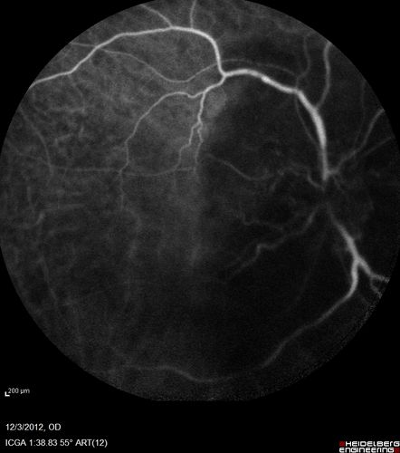 Uveitis - Retinitis - Vasculitis - possibly Syphilitis
Visit 1: 12-06-12
74-year-old man 12-3-12 visit.  2 months ago noticed vision loss, first in the right eye than the left.   He is getting tired easily.  He canâ€™t walk for a long distance.  He has lost five pounds within the last month. He also had a severe itchy episode, but not quite a rash a few days ago, which went away after he took a shower.  FTA-ABS is positive but a spinal tap, which was negative.  OD 1/200,  OS 20/63.  

