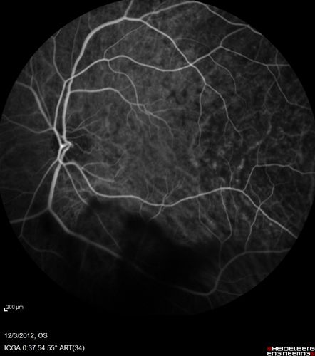 Uveitis - Retinitis - Vasculitis - possibly Syphilitis
Visit 1: 12-06-12
74-year-old man 12-3-12 visit.  2 months ago noticed vision loss, first in the right eye than the left.   He is getting tired easily.  He canâ€™t walk for a long distance.  He has lost five pounds within the last month. He also had a severe itchy episode, but not quite a rash a few days ago, which went away after he took a shower.  FTA-ABS is positive but a spinal tap, which was negative.  OD 1/200,  OS 20/63.  
