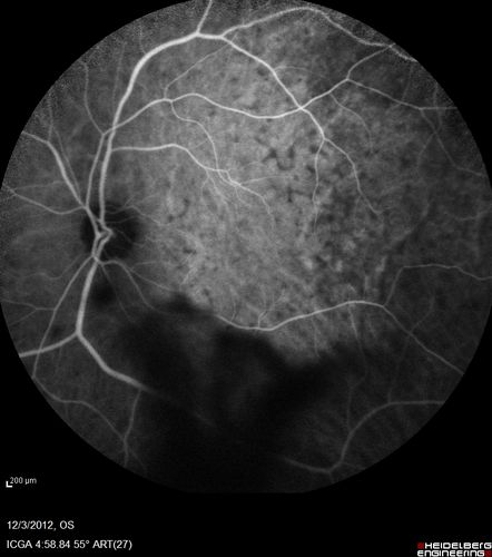 Uveitis - Retinitis - Vasculitis - possibly Syphilitis
Visit 1: 12-06-12
74-year-old man 12-3-12 visit.  2 months ago noticed vision loss, first in the right eye than the left.   He is getting tired easily.  He canâ€™t walk for a long distance.  He has lost five pounds within the last month. He also had a severe itchy episode, but not quite a rash a few days ago, which went away after he took a shower.  FTA-ABS is positive but a spinal tap, which was negative.  OD 1/200,  OS 20/63.  
