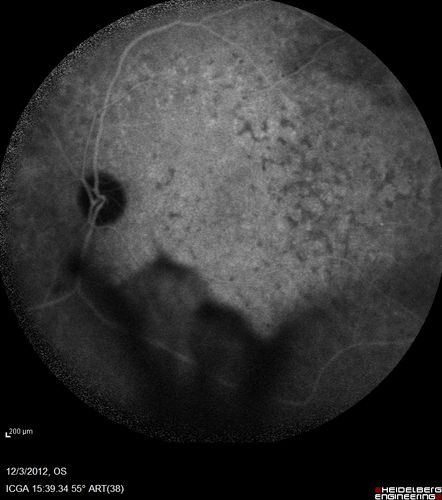 Uveitis - Retinitis - Vasculitis - possibly Syphilitis
Visit 1: 12-06-12
74-year-old man 12-3-12 visit.  2 months ago noticed vision loss, first in the right eye than the left.   He is getting tired easily.  He canâ€™t walk for a long distance.  He has lost five pounds within the last month. He also had a severe itchy episode, but not quite a rash a few days ago, which went away after he took a shower.  FTA-ABS is positive but a spinal tap, which was negative.  OD 1/200,  OS 20/63.  
