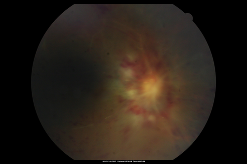 Vasculitis - Retinitis - Uveitis - Vision NLP right eye , 20/50 left eye
