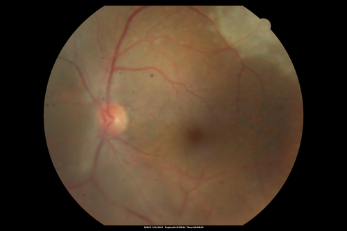 Vasculitis - Retinitis - Uveitis - Vision NLP right eye , 20/50 left eye
