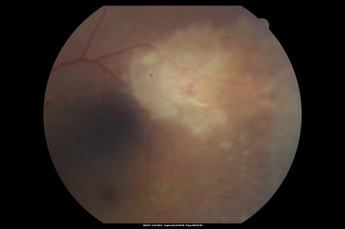 Vasculitis - Retinitis - Uveitis - Vision NLP right eye , 20/50 left eye
