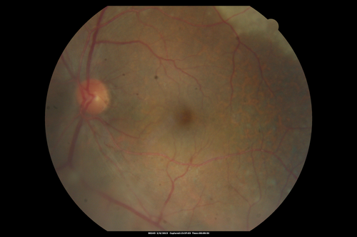 Vasculitis - Retinitis - Uveitis - Vision NLP right eye , 20/50 left eye
