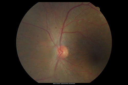 Vasculitis - Retinitis - Uveitis - Vision NLP right eye , 20/50 left eye
