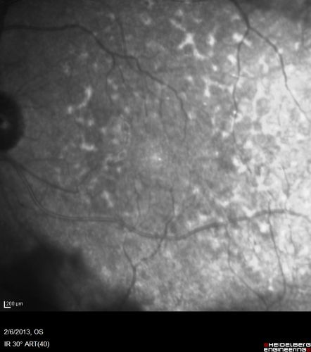 Vasculitis - Retinitis - Uveitis - Vision NLP right eye , 20/50 left eye
