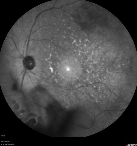 Vasculitis - Retinitis - Uveitis - Vision NLP right eye , 20/50 left eye
