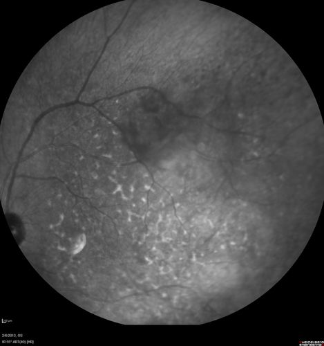 Vasculitis - Retinitis - Uveitis - Vision NLP right eye , 20/50 left eye
