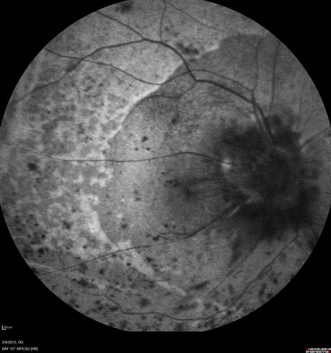 Vasculitis - Retinitis - Uveitis - Vision NLP right eye , 20/50 left eye
