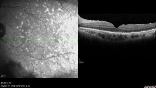 Vasculitis - Retinitis - Uveitis - Vision NLP right eye , 20/50 left eye
