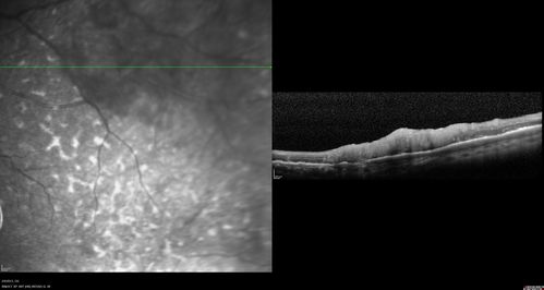Vasculitis - Retinitis - Uveitis - Vision NLP right eye , 20/50 left eye
