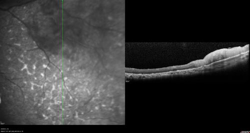 Vasculitis - Retinitis - Uveitis - Vision NLP right eye , 20/50 left eye
