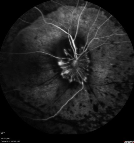 Vasculitis - Retinitis - Uveitis - Vision NLP right eye , 20/50 left eye
