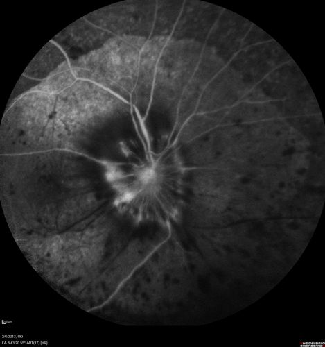 Vasculitis - Retinitis - Uveitis - Vision NLP right eye , 20/50 left eye
