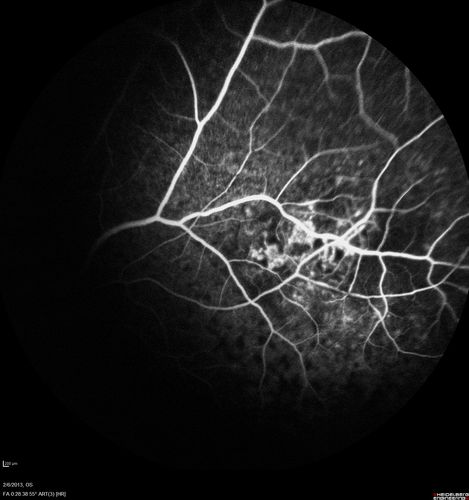 Vasculitis - Retinitis - Uveitis - Vision NLP right eye , 20/50 left eye
