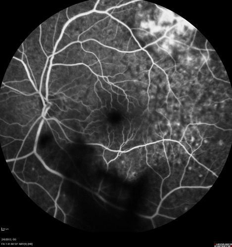 Vasculitis - Retinitis - Uveitis - Vision NLP right eye , 20/50 left eye
