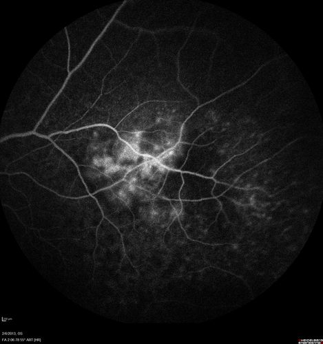 Vasculitis - Retinitis - Uveitis - Vision NLP right eye , 20/50 left eye
